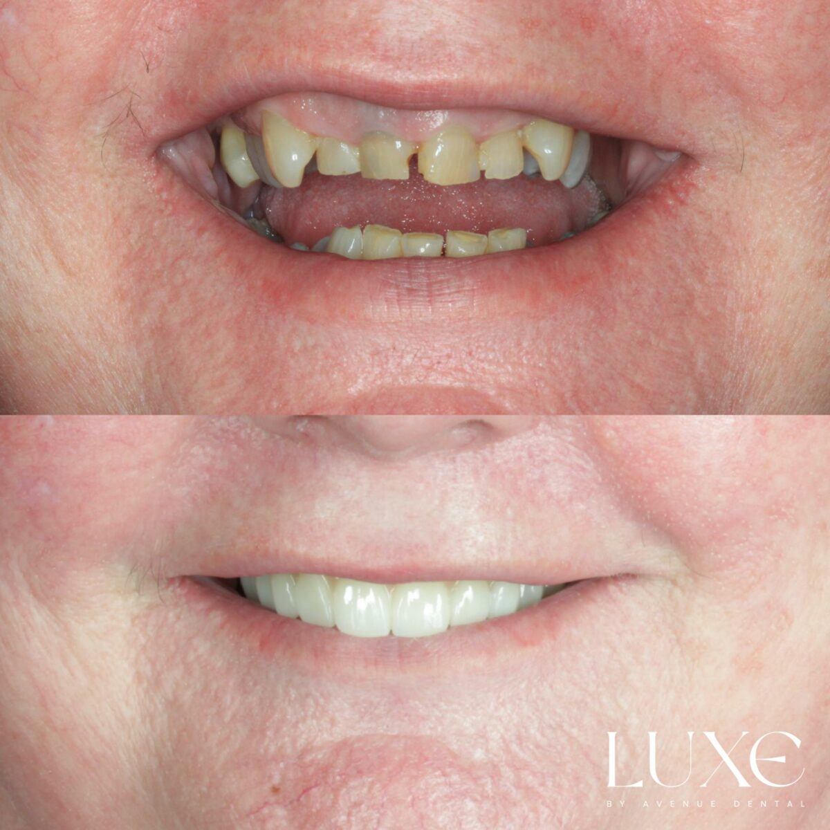 Luxe Dental Allonfour Results (2)