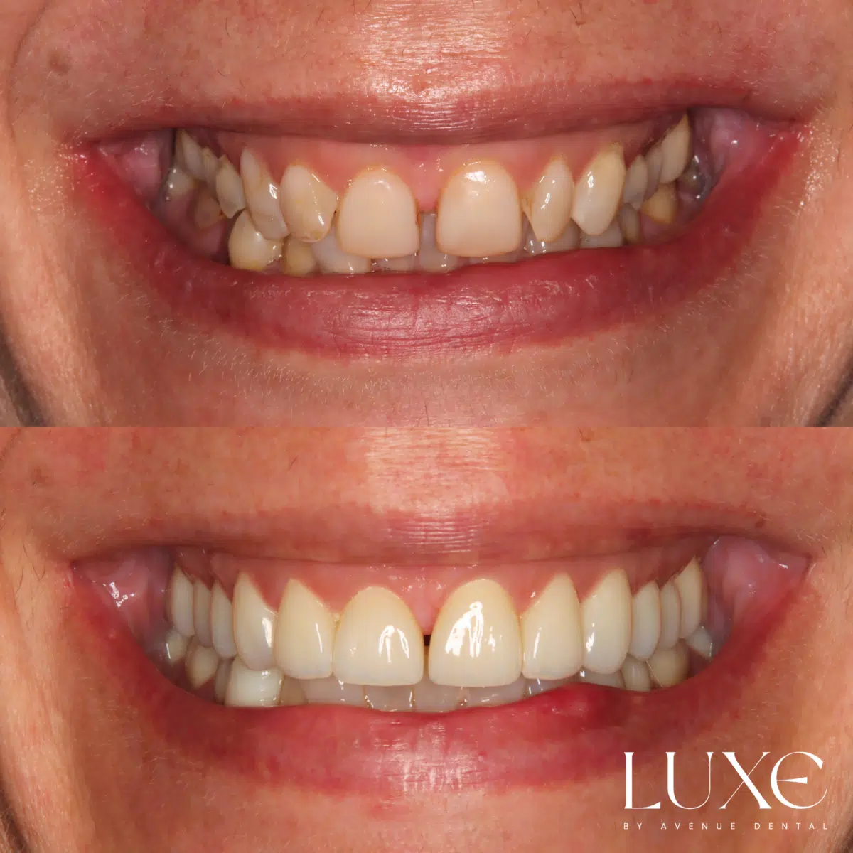 Luxe Dental Veneers Before After (3)