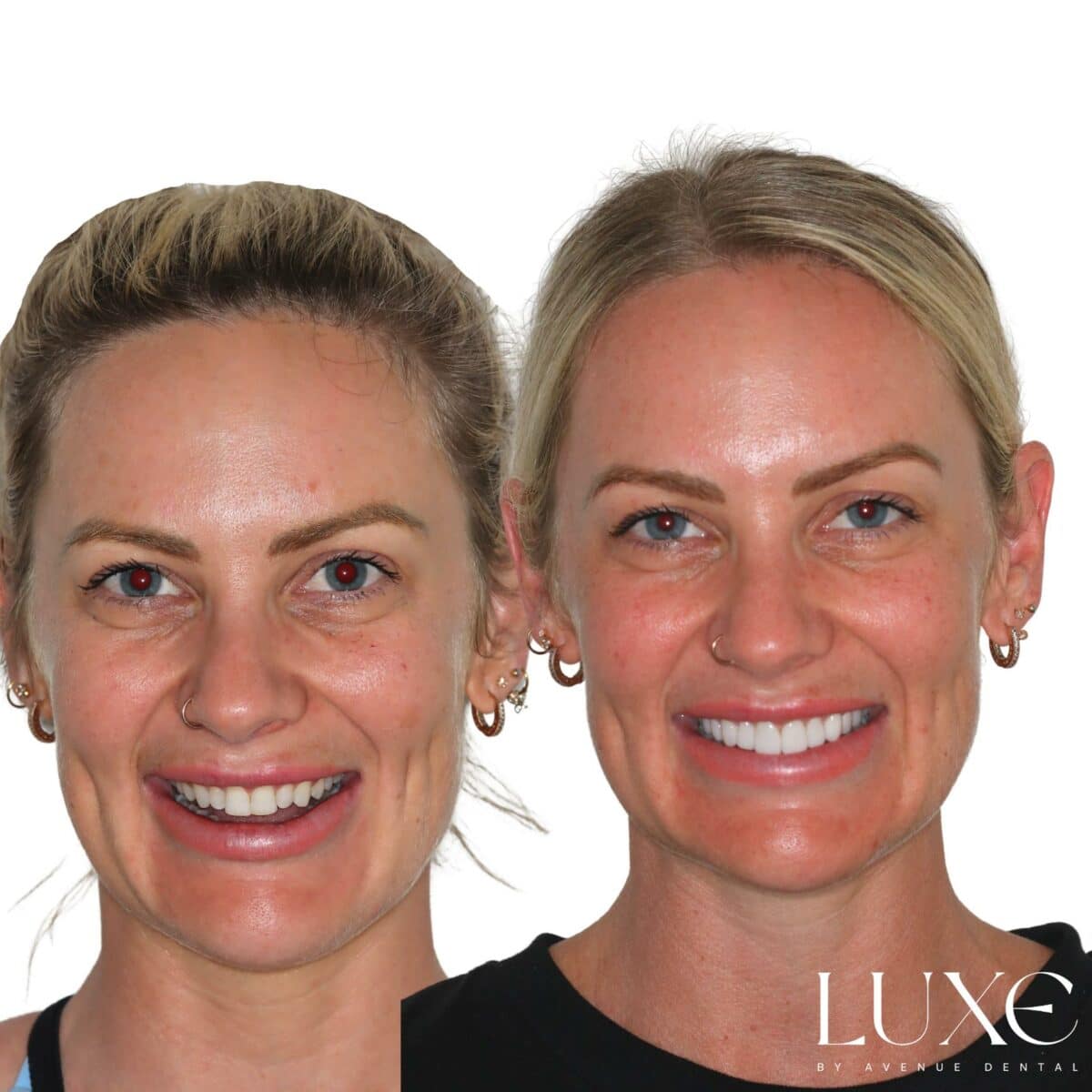 Luxe Dental Veneers Results (1)