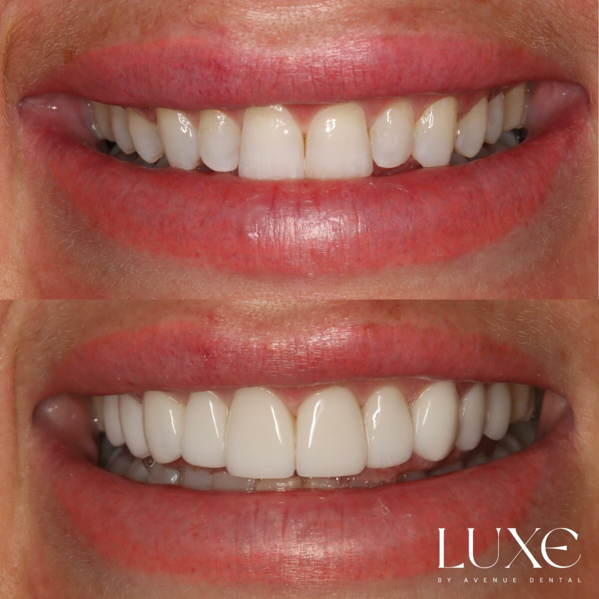 Luxe Dental Veneers Results (2)